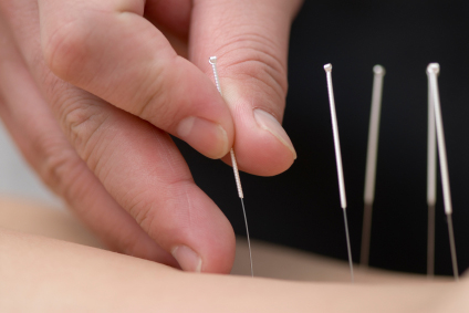 Ist Akupunktur steuerlich absetzbar?