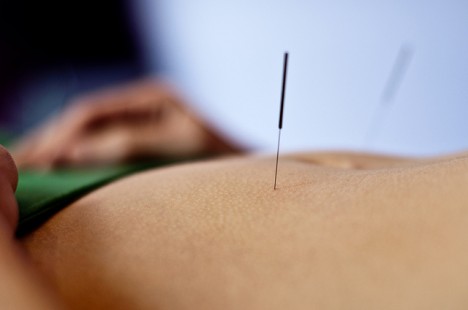 Akupunktur gehört zu den anerkanntesten Heilverfahren der Traditionellen Chinesischen Medizin