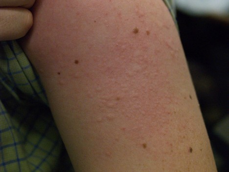Allergische Hautreizung: Immer mehr Menschen sind von solchen oder ähnlichen allergischen Reaktionen des Körpers betroffen