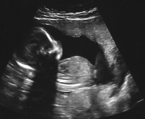 Die meisten kennen Ultraschall durch die Schwangerschaftsvorsorge. Weniger bekannt ist, dass Ultraschall auch als Umwelt-Störfaktor immer häufiger in Erscheinung tritt