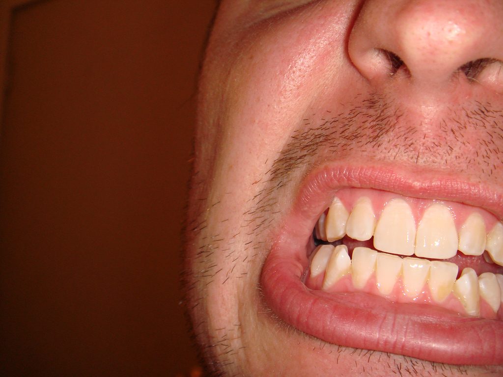 Beginnender Zahnfleischschwund bei einem jungen Mann. Foto (C)Gregg O´Connell / flickr BY CC 2.0