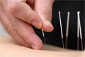 Mediziner beim Setzen von Akupunkturnadeln